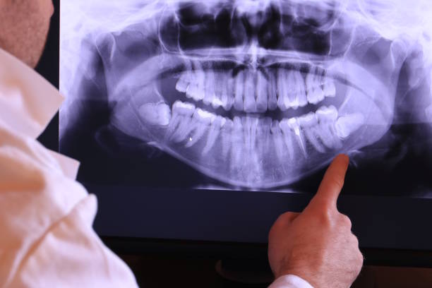 Best Knocked-Out Tooth (Avulsed Tooth) Treatment in Chalco, NE